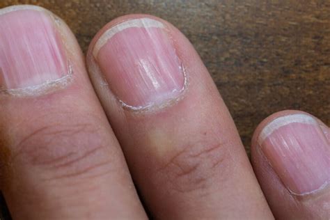 rayas en las uñas enfermedad